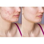 Dr. Belmeur Spot Care Ampoule 22ml - soothing serum with panthenol, beta-glucan, chaga mushroom and tea tree oil against blemishes and redness. Picture before / after. 