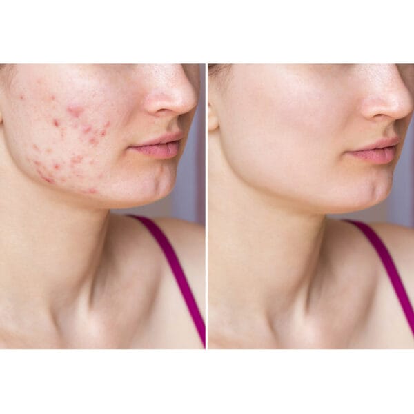 Dr. Belmeur Spot Care Ampoule 22ml - soothing serum with panthenol, beta-glucan, chaga mushroom and tea tree oil against blemishes and redness. Picture before / after. 